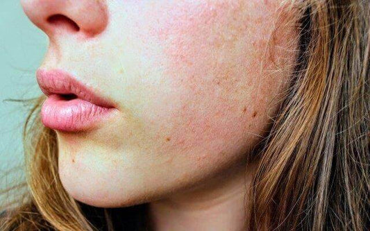 Treat Your Skin Problems The Natural Way